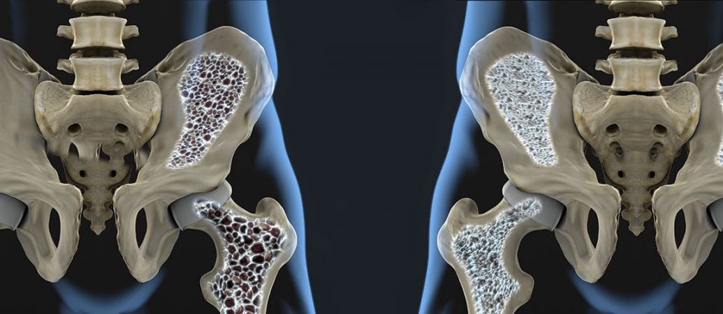 Die Biologie hinter Osteoporose in neuer Studie aufgedeckt