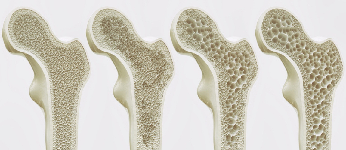 Blocking Estrogen Receptors in Brain Boosts Bone Mass